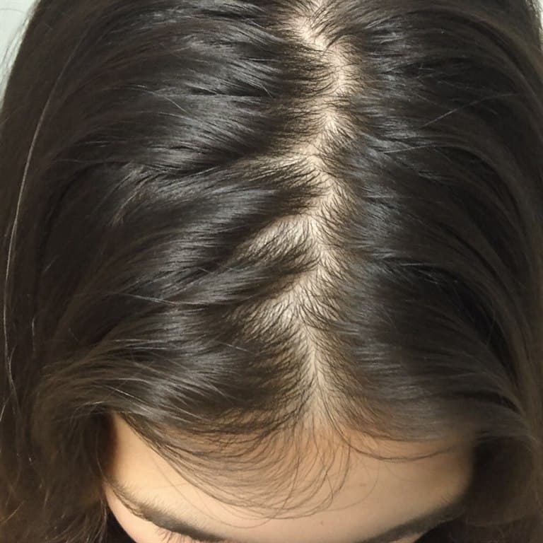 Detalhe do couro cabeludo